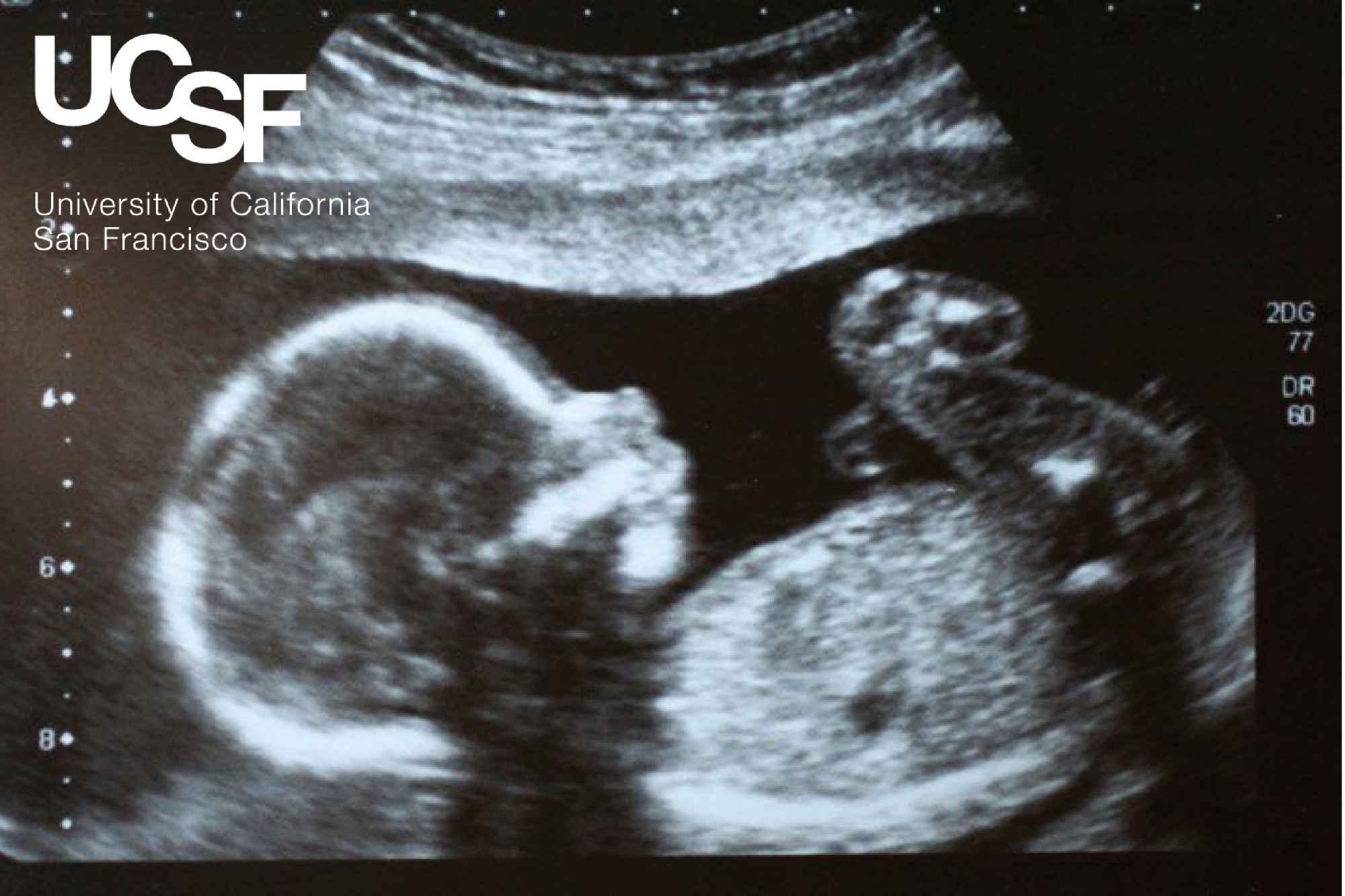 ultrasound with ucsf logo